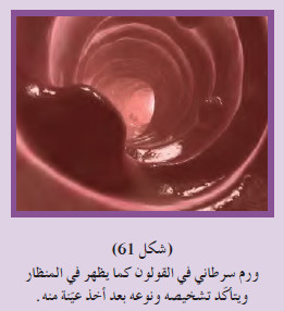 أسباب الإصابة بالسرطان