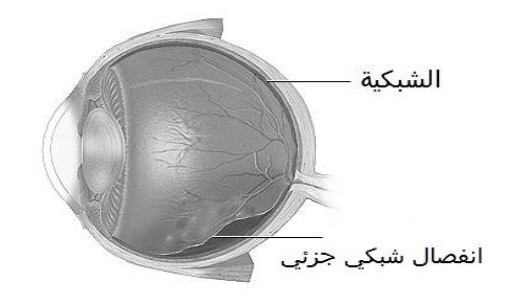 انفصال الشبكية