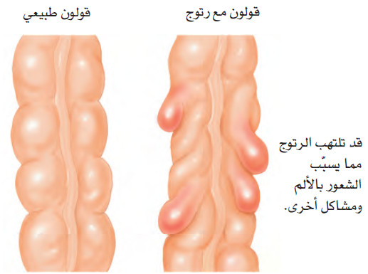 التهاب الرتوج بسبب قلة الألياف